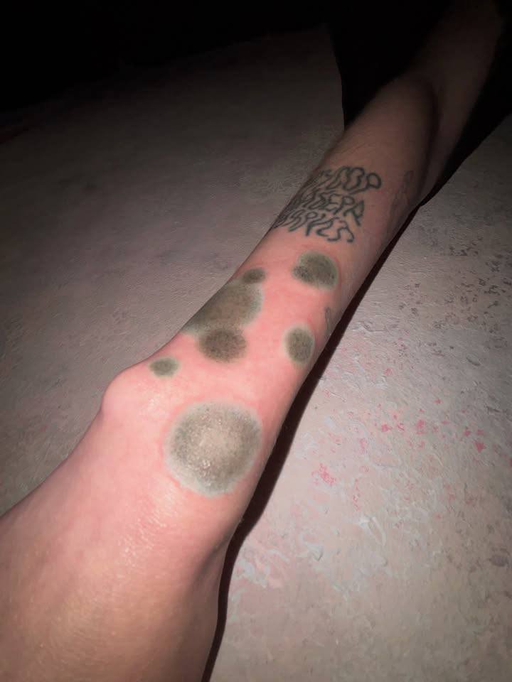 Carolus_XII_Rex's tweet photo. 🇷🇺Moscow: Gen Z are queuing for viral tattoos that make their skin look moldy, infected and literally rotting. https://t.co/XlpjnTxQPL