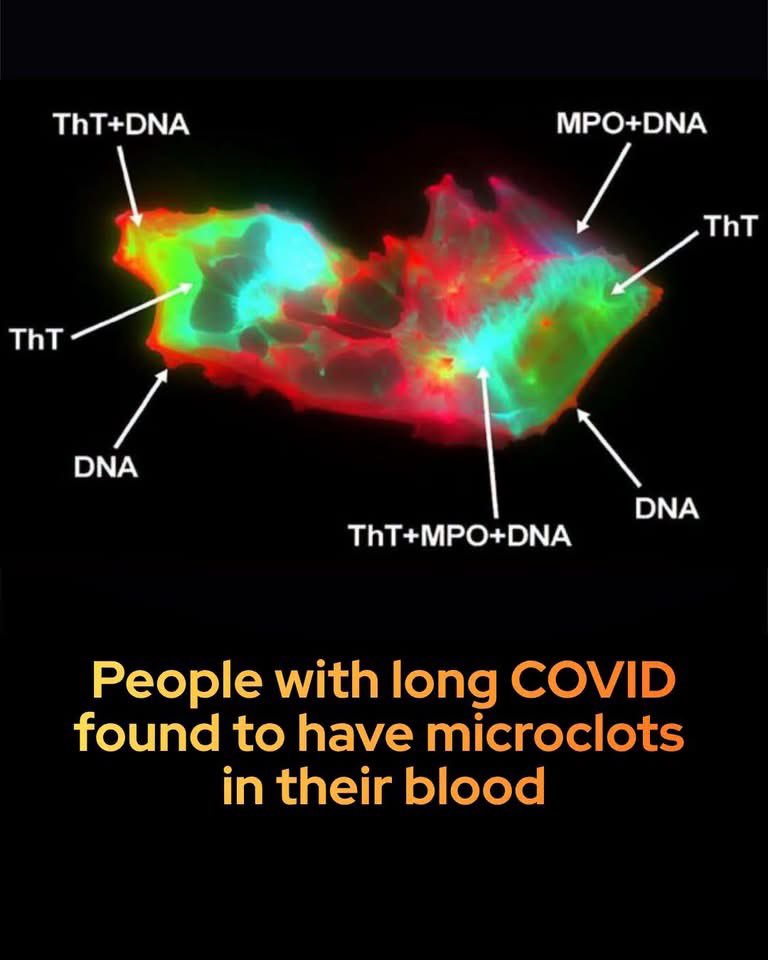 SmartScience's tweet photo. Scientists just found a reason for the exhaustion of long COVID — microscopic clots in the blood.

The study was published in the Journal of Medical Virology.

Researchers discovered that patients with the condition have nearly twenty times more microscopic blood clots than healthy individuals. Unlike typical clots, these 'microclots' are wrapped in sticky, web-like structures made of DNA and enzymes released by white blood cells. 

These webs, known as neutrophil extracellular traps (NETs), act as structural armor, preventing the body from naturally breaking down the clots. This leads to a persistent blockage in the capillaries—the body's smallest blood vessels—which starves tissues of oxygen and drives chronic inflammation.

This discovery marks a massive shift in how post-viral illnesses are understood. Historically, many Long COVID patients struggled to find validation because standard blood tests routinely came back normal.

 By showing that these microscopic clots are structurally bound to NETs, scientists are paving the way for targeted treatments, such as therapies designed to dissolve these persistent blocks. It also offers a glimmer of hope for millions suffering from other poorly understood chronic conditions, such as Myalgic Encephalomyelitis/Chronic Fatigue Syndrome (ME/CFS), where similar microclotting patterns have been observed.

source: Thierry, A. R., Usher, T., Sanchez, C., Turner, S., Venter, C., Pastor, B., Waters, M., Thompson, A., Mirandola, A., Pisareva, E., Prevostel, C., Laubscher, G. J., Kell, D. B., & Pretorius, E. Circulating Microclots Are Structurally Associated With Neutrophil Extracellular Traps and Their Amounts Are Elevated in Long COVID Patients. Journal of Medical Virology, 97(10), e70613.