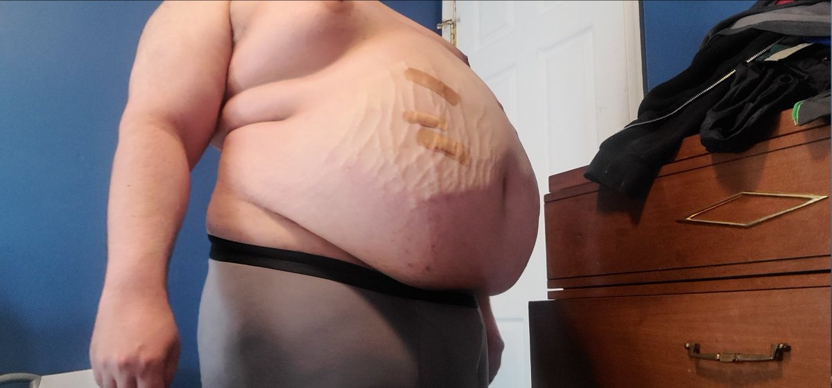 ZPumpAddict's tweet photo. Some pics , 4L saline infusion https://t.co/AXeVfhPr5W