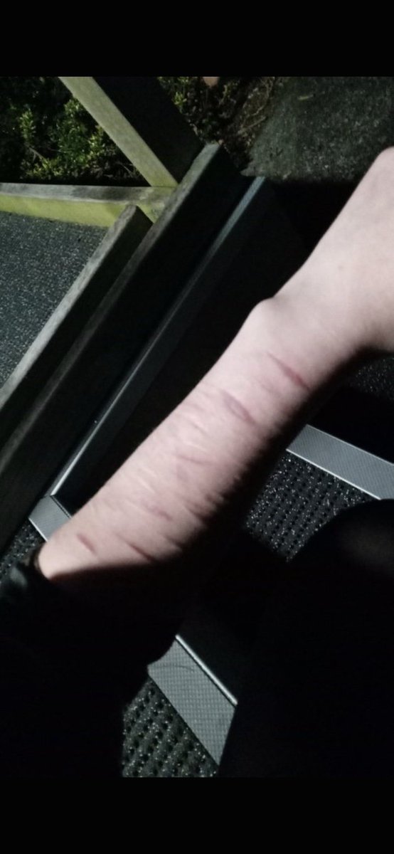 mayreignforest's tweet photo. found my scars from a few years ago they look so lame now 😓☝️ https://t.co/Kza6VrSxWU