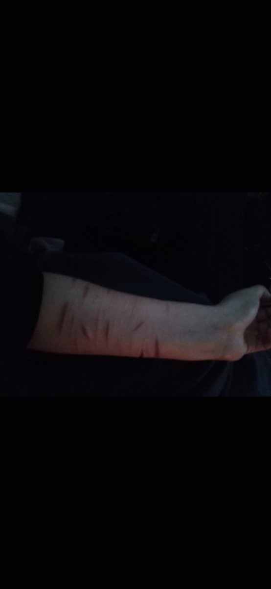 mayreignforest's tweet photo. found my scars from a few years ago they look so lame now 😓☝️ https://t.co/Kza6VrSxWU
