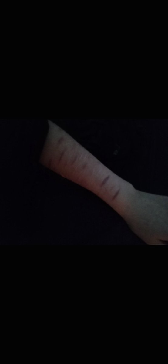 mayreignforest's tweet photo. found my scars from a few years ago they look so lame now 😓☝️ https://t.co/Kza6VrSxWU