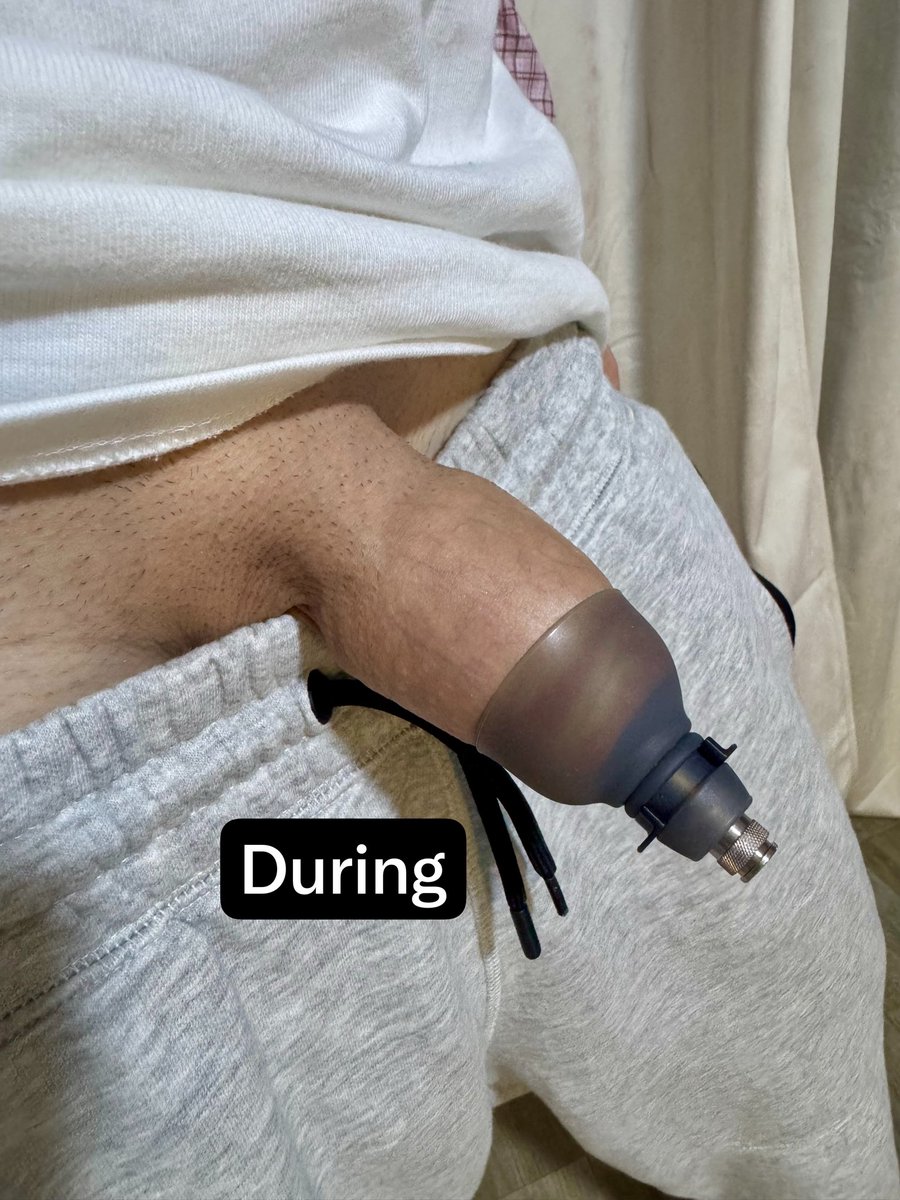 ForeRestoring's tweet photo. I love how it looks for a few minutes when I remove the Priva Air device
Before - During - After
#foreskinrestoration 
#circumcised https://t.co/hlgD4RI9i1