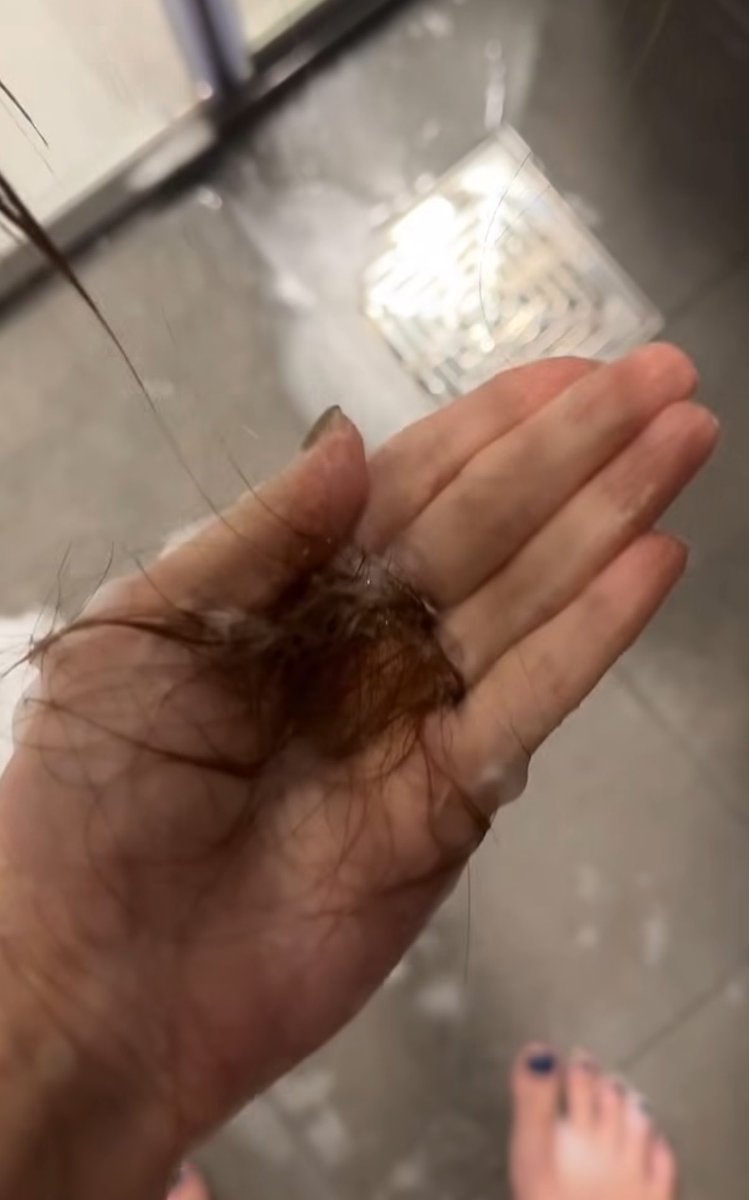 Buldakguy's tweet photo. 마운자로 맞으신 분들 머리 많이 빠짐?

이건 진짜 심한거 아닌가
마운자로 맞은 분들 후기 좀 부탁드립니다.

(출처:인스타ssong_gree) https://t.co/zy4SQbLf8m