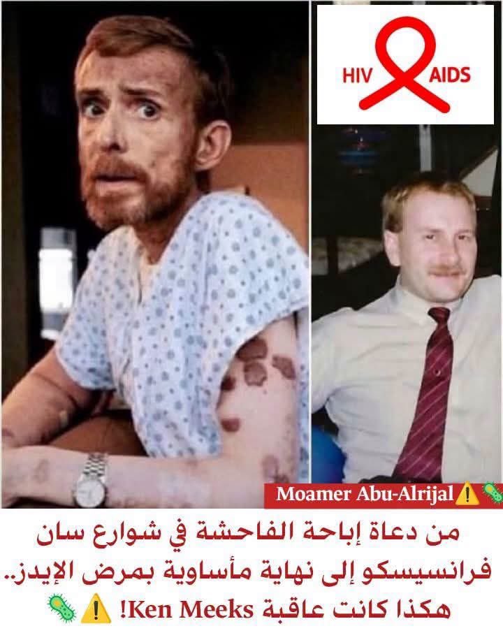 akiluno_a's tweet photo. ⚠️ قصة للعبرة.. لمن يطالب بإباحة الفاحشة! ⚠️

👤 الأمريكي Ken Meeks كان من أهم دعاة إباحة الزنى والفاحشة
📢 قاد مظاهرات كبرى في سان فرانسيسكو مطالباً بعدم تجريم الدعـ.ـارة!

💥 فكانت النهاية عبرة للجميع..

🦠 ابتلاه الله بمرض الإيدز بسبب علاقة غير شرعية
🤒 جسده بلا مناعة.. تذوق كل الأمراض
🩹 تقرحات.. أورام.. آلام لا تنتهي!
💀 من شدة عذابه حاول الانتحار وطلب الموت الرحيم.. حتى هلك عام 1986م

📊 واليوم في أمريكا وحدها:
🔴 1.2 مليون مصاب بالإيدز
⚫ 13,000 يموتون كل سنة!

قال تعالى:
﴿ وَلَا تَقْرَبُوا الزِّنَا ۖ إِنَّهُ كَانَ فَاحِشَةً وَسَاءَ سَبِيلًا ﴾ 🙏✨

#عبرة #قصص_واقعية #الزنا #الإيدز #تذكير #موعظة #نهاية_الظالم
(منقول)
