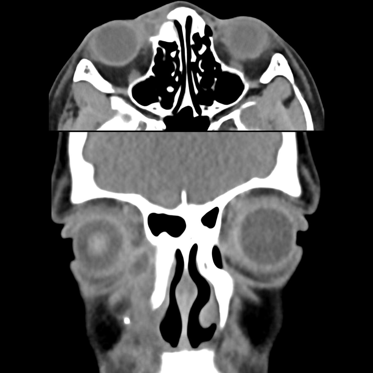 pedsimaging's tweet photo. School ager with excessive right-sided tearing after a right facial fracture
Axial (above)+coronal (below) CT show oval low density lesion with thin enhancing wall located along course of right nasolacrimal duct
#FOAMed #MedEd #FOAMRad #PedsRad #RadEd #radiology #radiologia https://t.co/3ev06EEstB