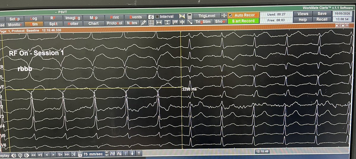ChekaMirror's tweet photo. 47F, left posteroseptal Kent https://t.co/mX3i495ITb
