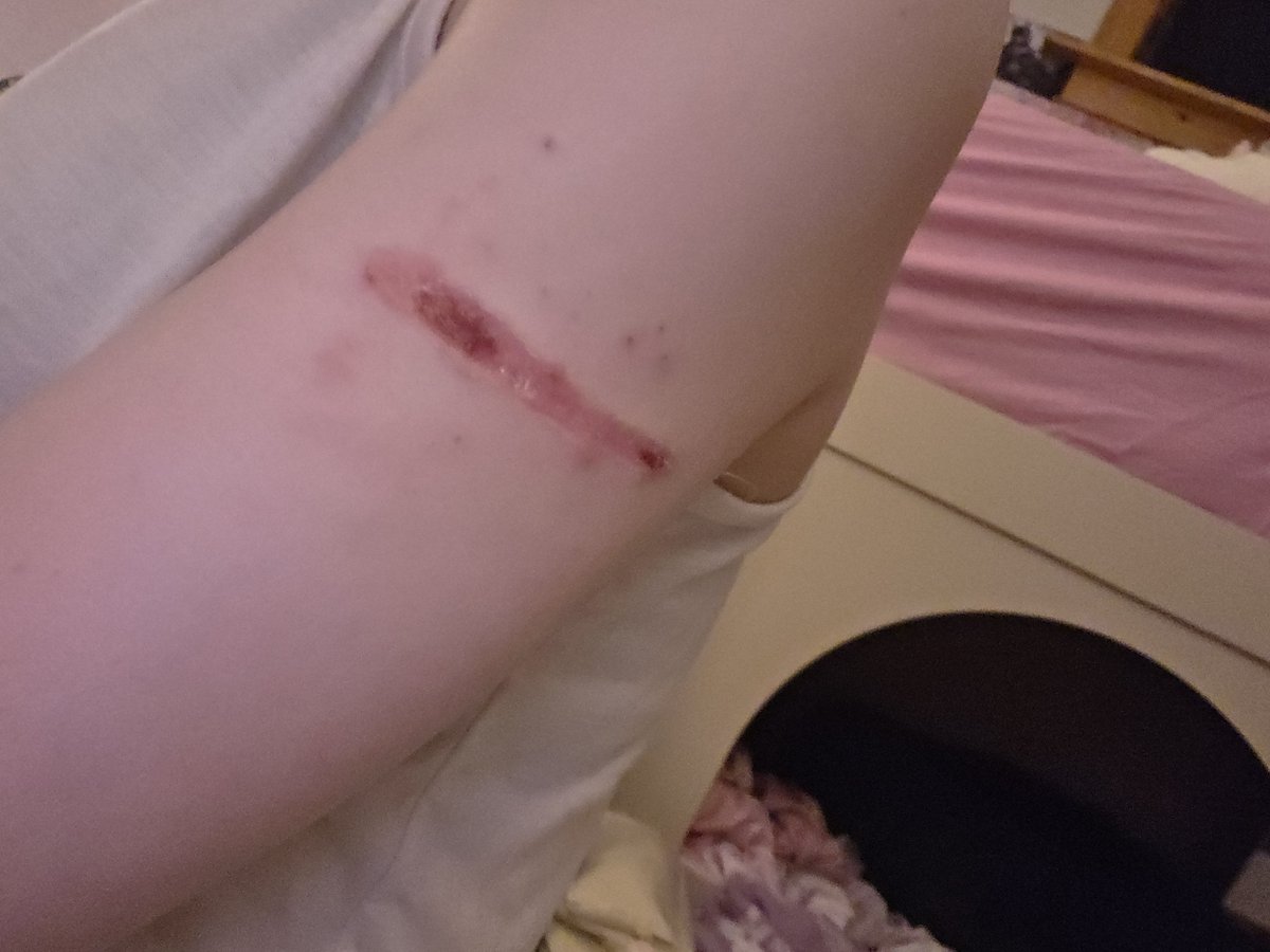 swiftstridemage's tweet photo. still upset i didnt get it the same depth fully across, this is what it is now almost fully healed. I wore a bandaid on it 2 times and they made my break out cause my skin hayes bandaids :( 

behind me is one of my cats littke nooks under my bed :3 https://t.co/jMJpRXlUnw