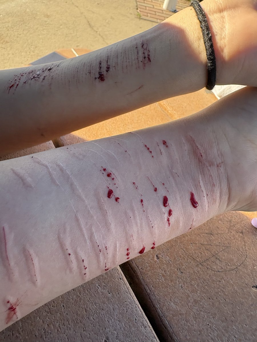 appledeerbabe's tweet photo. FAKE BODY!! #sfxmakeup #fake at the park today with my bff @vanilescenq ♡∞:｡.｡ v https://t.co/i0QCCaAAF3