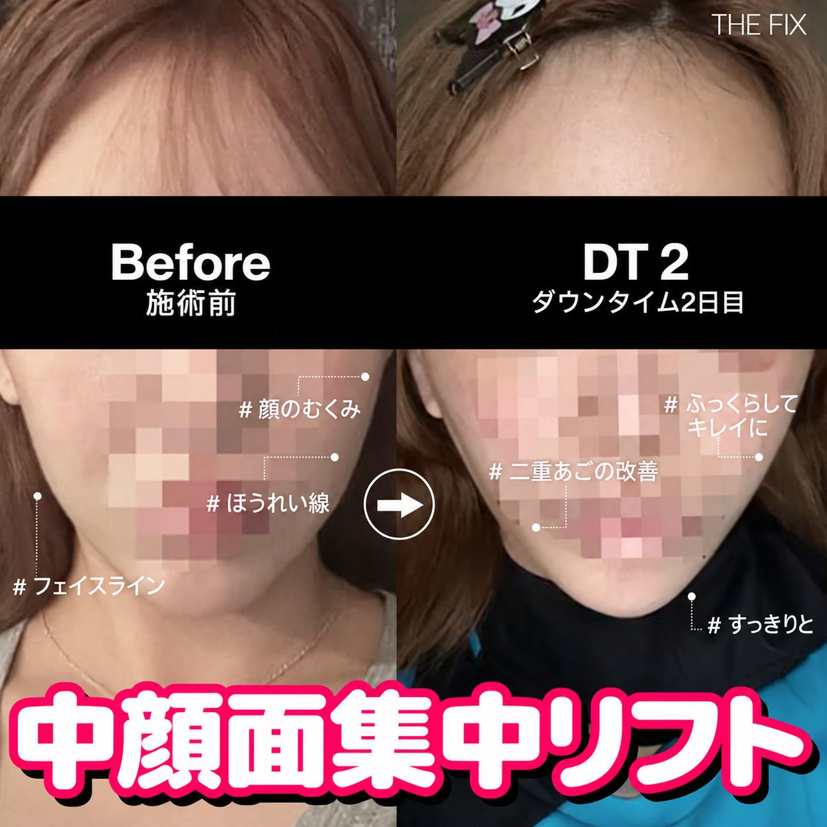 choedonghu43570's tweet photo. @@ザフィックス中顔面重点挙上@@@  鼻の手術？唇フィラー？？ もう終わり~！😂ザ·フィックスで顔面を重点的に挙上に 一気に！📷中顔面を中心に顔面挙上を行い たるんだ中顔面も解決し 元の輪郭より垂れ下がって見えるのを改善~！ たるみポイントを強固に固定し、さらに10年 若く見えるように https://t.co/3kiHXv9OAX