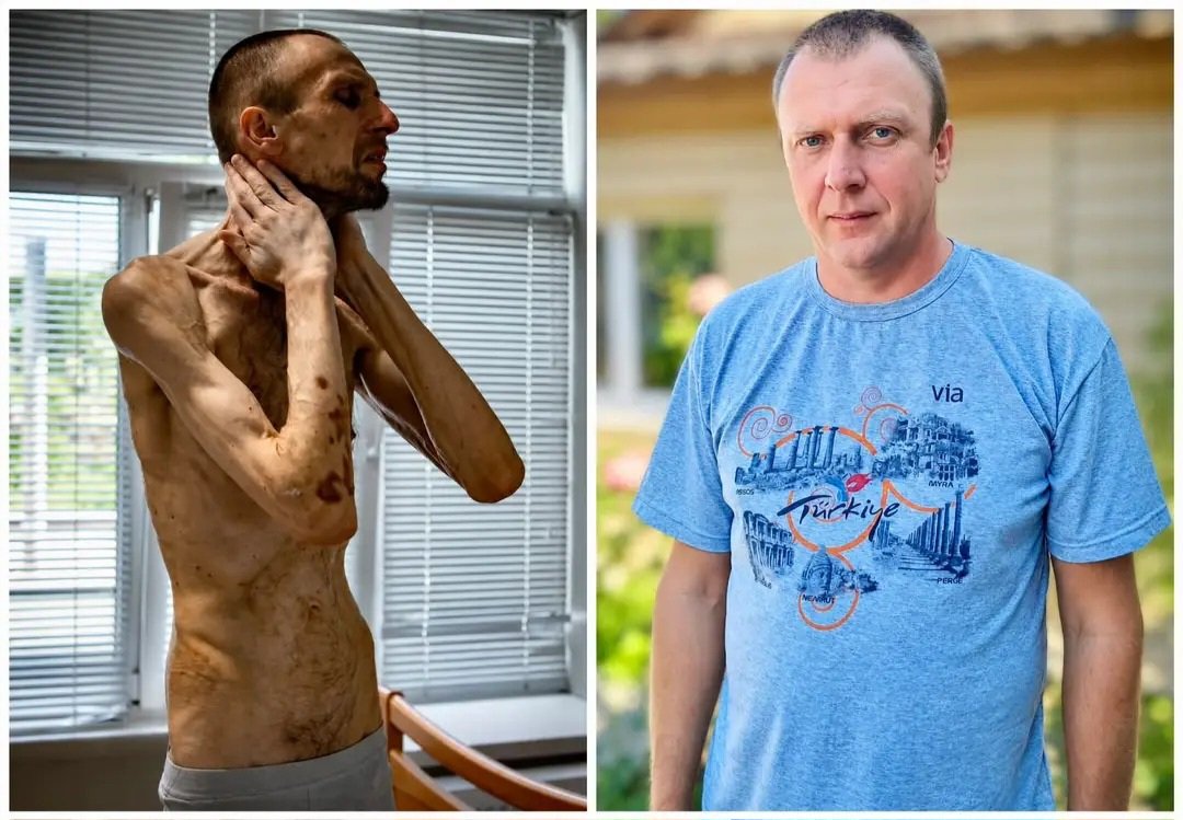 CrimeanVoyager's tweet photo. 95 kg when russians took him prisoner.

50 kg when he came home 27 months later.

Roman Horilyk, a Ukrainian National Guard soldier, endured hunger, torture and medical neglect in russian captivity.

He was freed on May 31, 2024.

He didn’t know he was going home.

With a bag over his head and his hands tied, he saw sunlight and clouds through the fabric as the plane began to land.

“It’s an exchange,” he realized.

Roman is home.

But hundreds of Ukrainian defenders are still in russian captivity.

They must come home too.

#FreeUkrainianPOWs