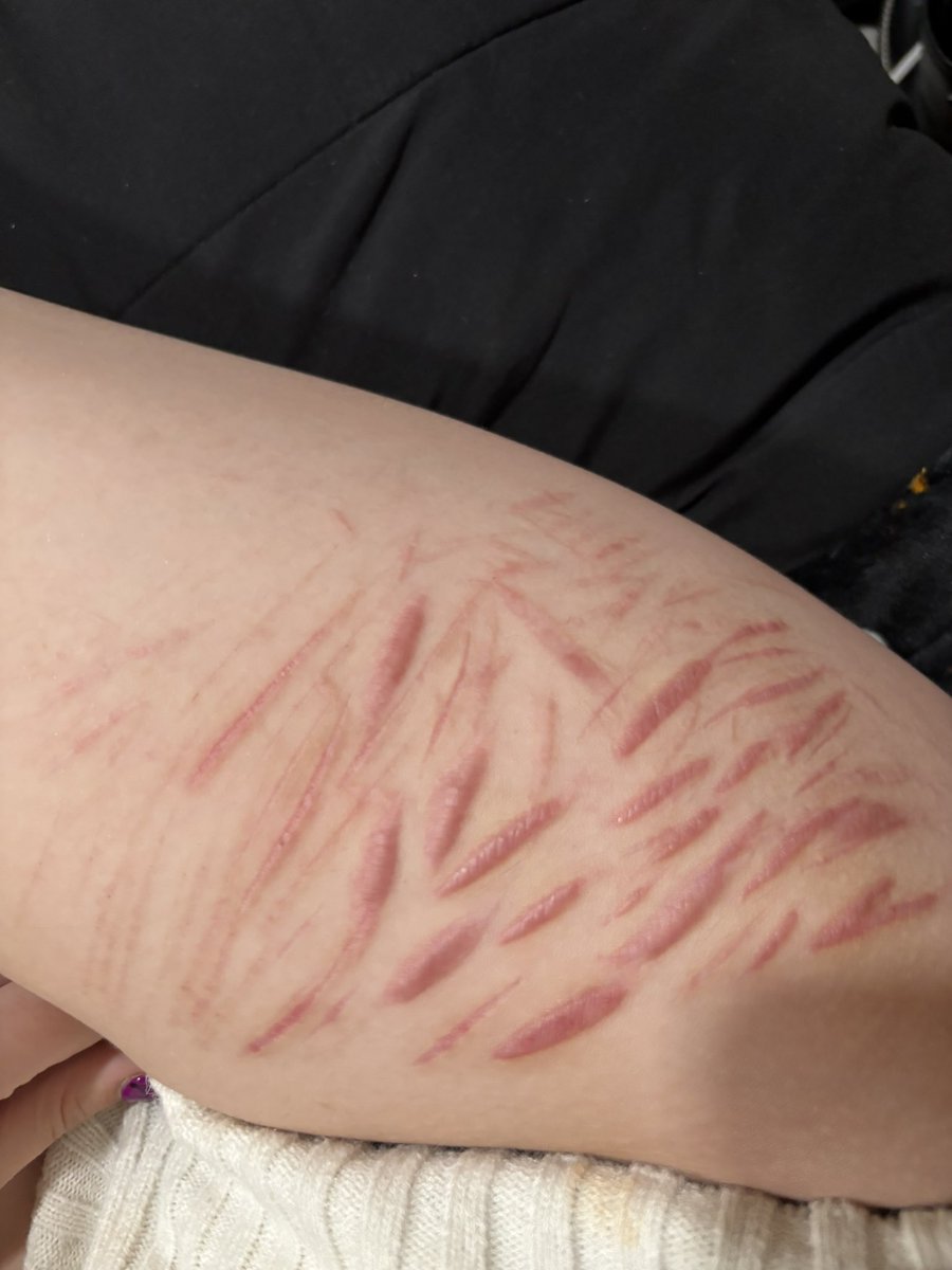 laycaffa's tweet photo. @Wrensparrows here’s the scar pics I have a lot more scars but these are these ones that are the only ones I can post 
FAKE SFX FAKE
#shedtwt #shtwt #scarspo https://t.co/xJLjUzLbKZ