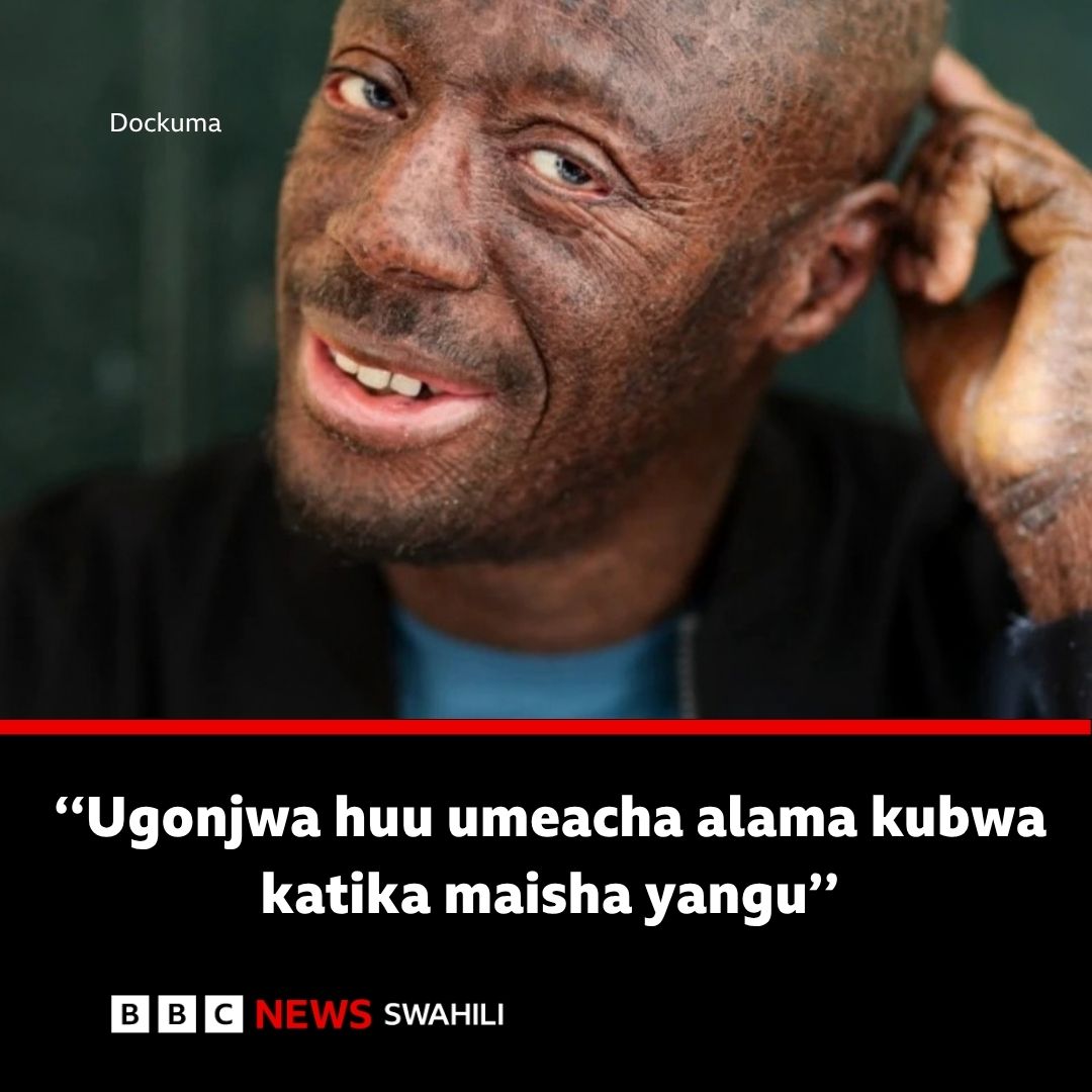 bbcswahili's tweet photo. Ichthyosis: 'Watu walinitazama kama mnyama wa kutisha' - Dockuma
https://t.co/7lrOE4jqmd https://t.co/NF2zigsX1r