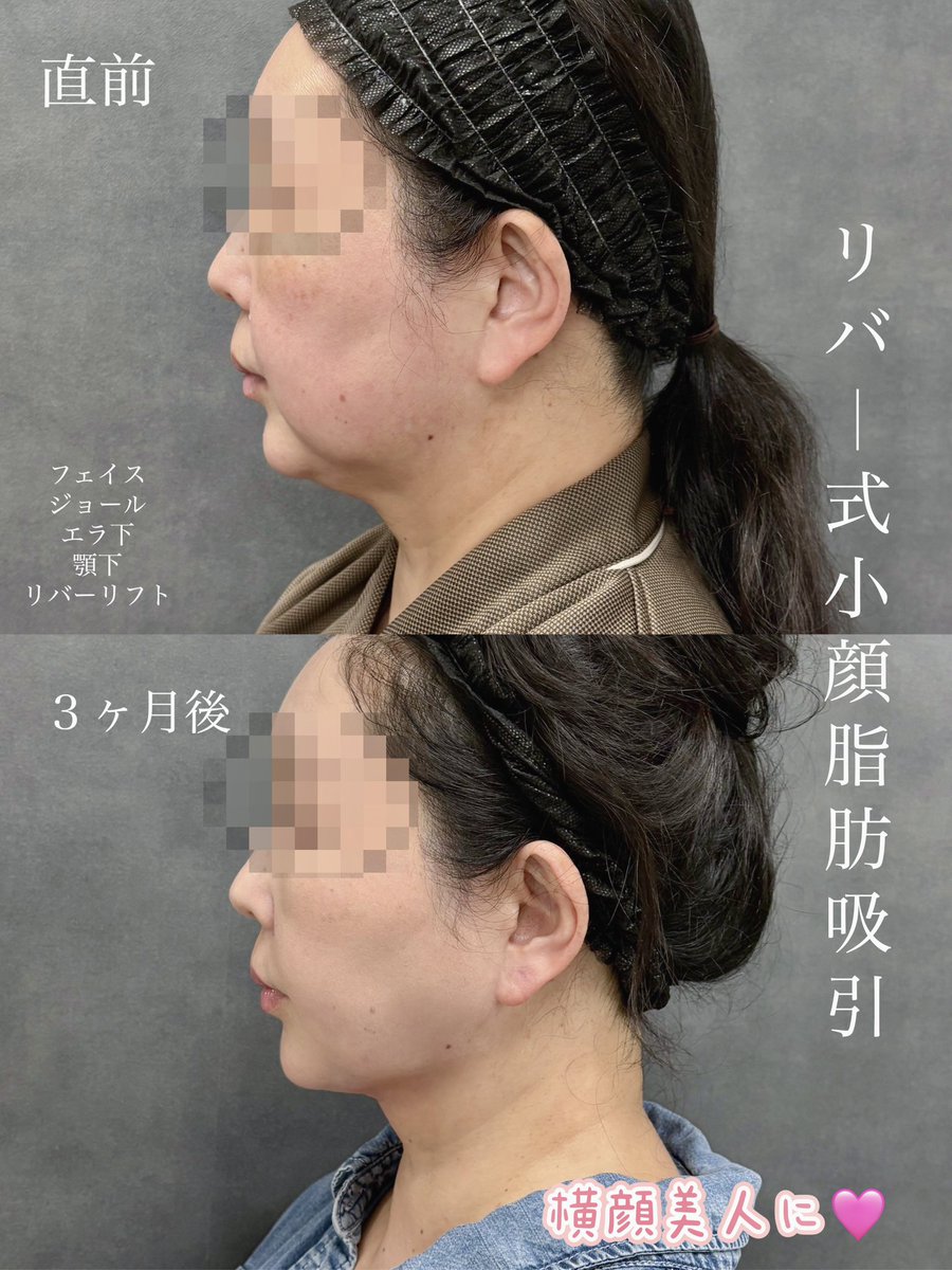 dr__kiya's tweet photo. 【脂肪吸引・バッカルファット DT経過】
しっかりたるみがでいてもここまで改善できます。バッカルファット は賛否両論ありますが適応がある方にはとても良い施術です🙆‍♀️若い方だけでなく幅広い年齢層に当院では人気です！ https://t.co/ZC2eZ09I2I