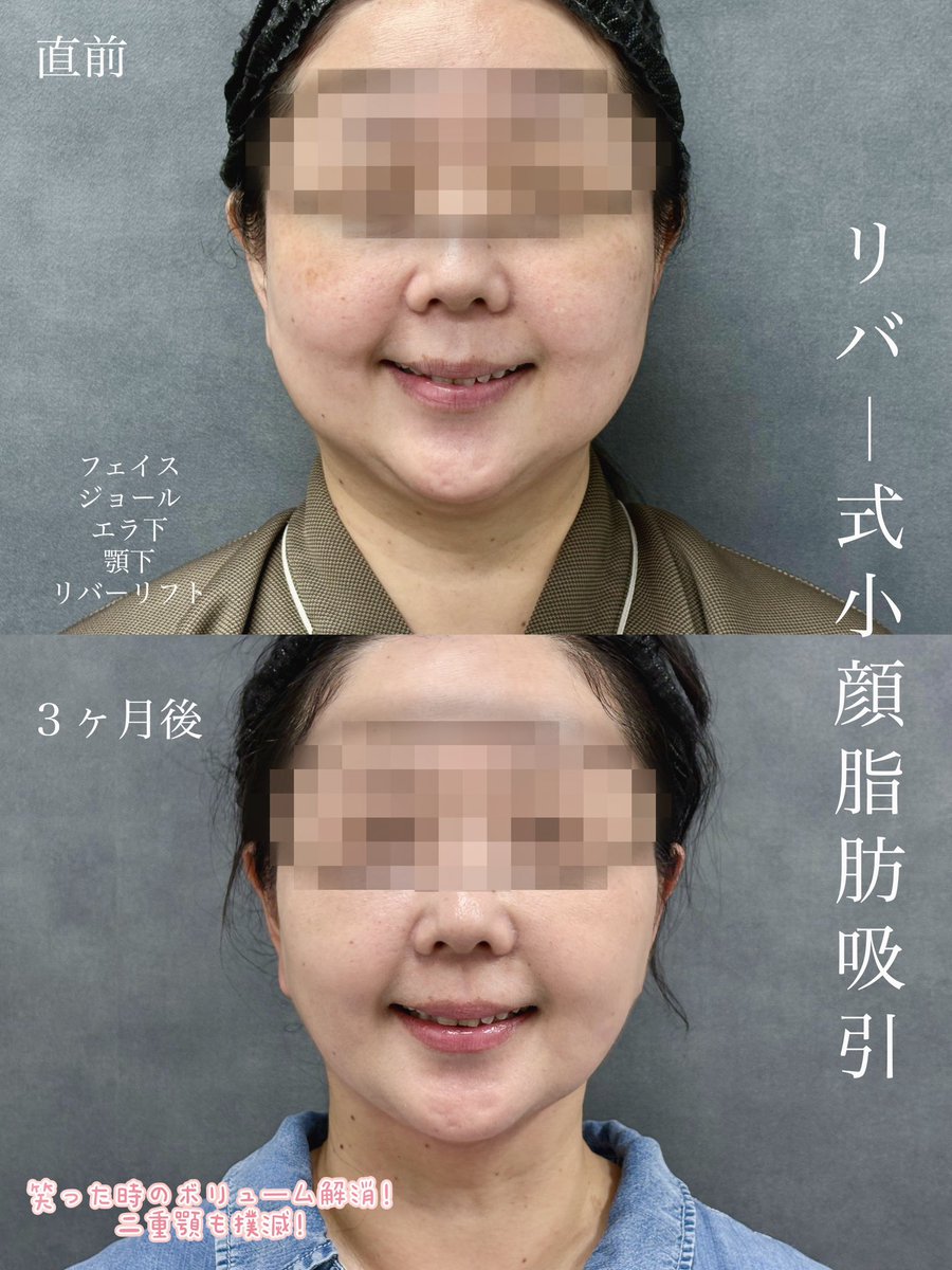 dr__kiya's tweet photo. 【脂肪吸引・バッカルファット DT経過】
しっかりたるみがでいてもここまで改善できます。バッカルファット は賛否両論ありますが適応がある方にはとても良い施術です🙆‍♀️若い方だけでなく幅広い年齢層に当院では人気です！ https://t.co/ZC2eZ09I2I