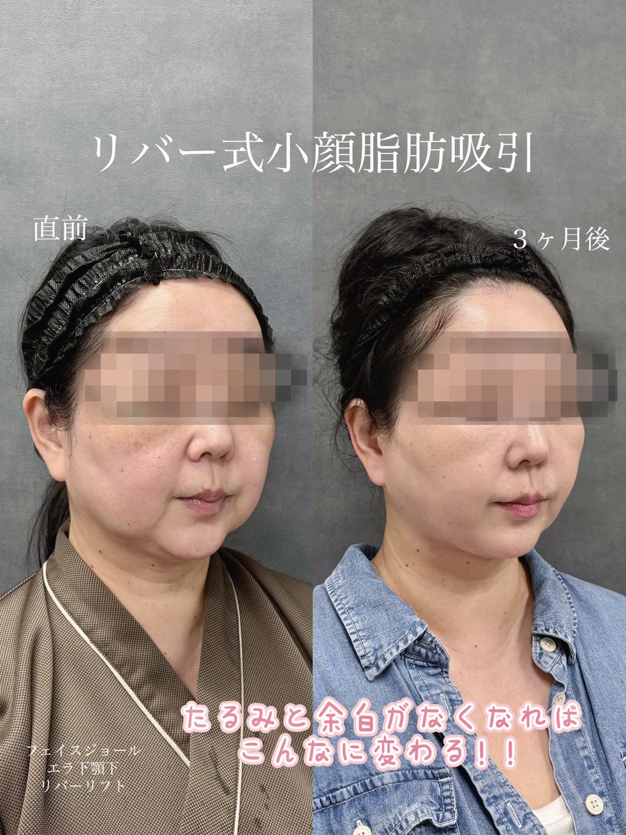 dr__kiya's tweet photo. 【脂肪吸引・バッカルファット DT経過】
しっかりたるみがでいてもここまで改善できます。バッカルファット は賛否両論ありますが適応がある方にはとても良い施術です🙆‍♀️若い方だけでなく幅広い年齢層に当院では人気です！ https://t.co/ZC2eZ09I2I