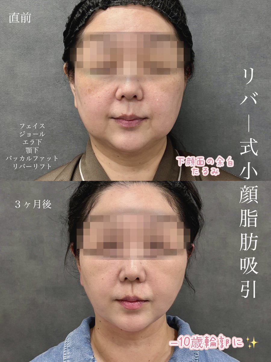dr__kiya's tweet photo. 【脂肪吸引・バッカルファット DT経過】
しっかりたるみがでいてもここまで改善できます。バッカルファット は賛否両論ありますが適応がある方にはとても良い施術です🙆‍♀️若い方だけでなく幅広い年齢層に当院では人気です！ https://t.co/ZC2eZ09I2I