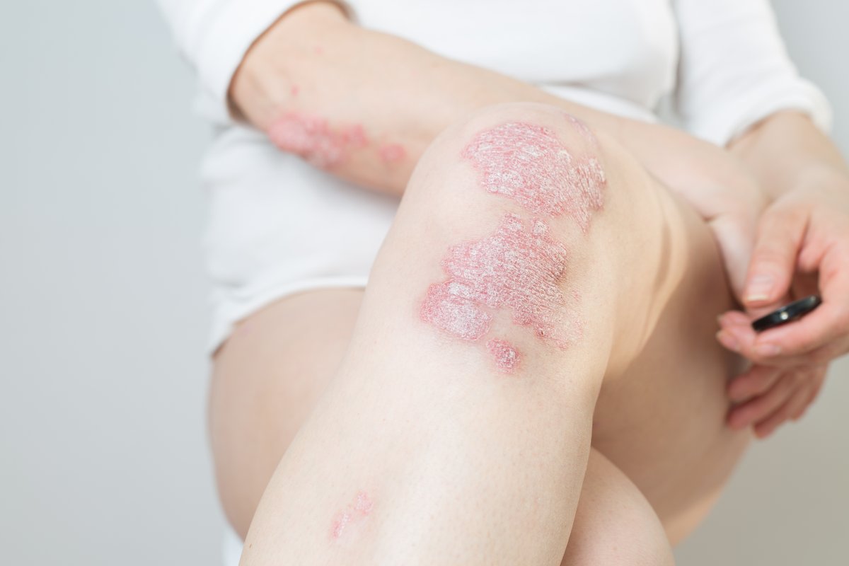 Practical_Derm's tweet photo. 📊👨‍⚕️🎤ICOTROKINRA UPDATE: New two-year phase 3 ICONIC-TOTAL data presented at EADV 2026 showed sustained responses with oral icotrokinra among adults and adolescents with plaque psoriasis involving high-impact sites.

Read more ➡️ https://t.co/UDvmA9EFlR

 #Icotrokinra #PlaquePsoriasis #EADV2026 #SkinHealth