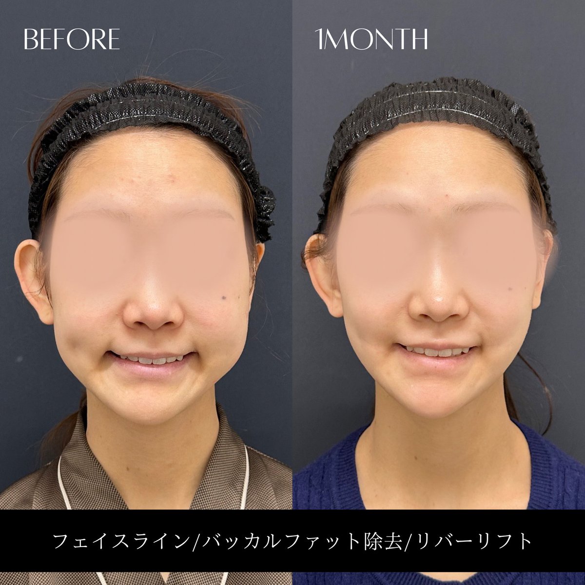 _RIVERCLINIC's tweet photo. 笑った時のこの膨らみ、気になりませんか？
それ、バッカルファット除去で解決できるかもしれません。

バッカルファットは誰にでもある脂肪ですが、量が多い方では、笑った時の頬の膨らみや下膨れ感の原因になっていることがあります。

こういう方は、皮下脂肪だけを吸引するよりも、バッカルファットを適量除去することでスッキリすることがあります。

ただし、バッカルファットは「取れば取るほどいい」施術ではありません。

元々少ない方から取ったり、多い方でも取りすぎたりすると、術後すぐにコケる場合もあれば、半年ほど経って完成した頃、あるいは加齢で顔の脂肪が減ってきた時にコケが目立つこともあります。

だから自分は、診察・触診でバッカルファットの量を見極めて、その人に必要な分だけ取ることを大切にしています。

適応がある方なら、笑った時の膨らみまで根本的に変えられて、変化量もかなり大きい施術です。

「自分は脂肪吸引？バッカル？両方？」という方は診察で判断します。
