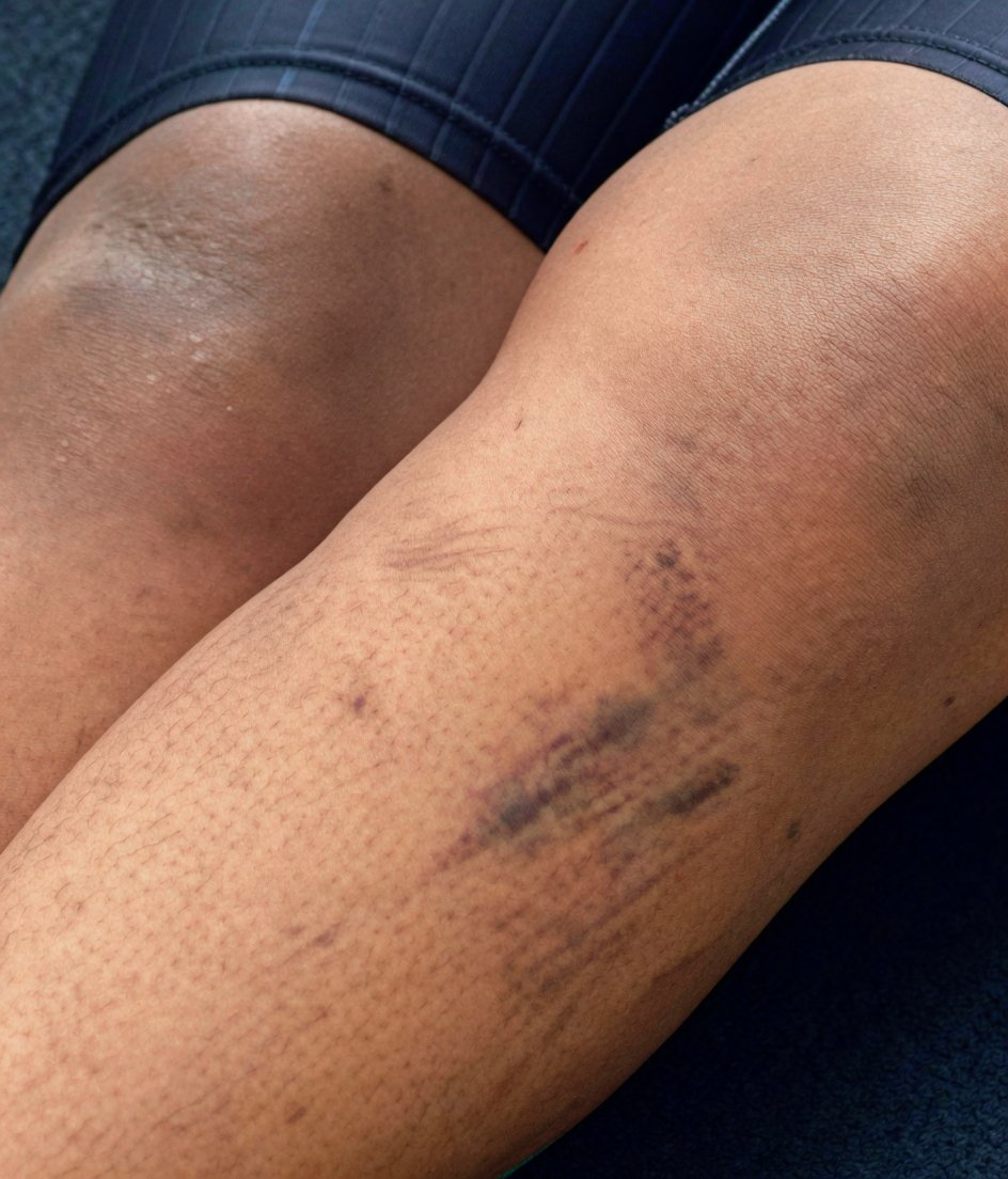 Pellerfam_'s tweet photo. This Infection looking stinking Fufu amoeba TOTO girl is being foolish with her Fish brain😏😒

You started this nonsense few months back and now you're Crying 😂 

Look at you disgusting Skin like a pig's own..
My advice to you is to treat that infection away from your body https://t.co/m1PGBlj226