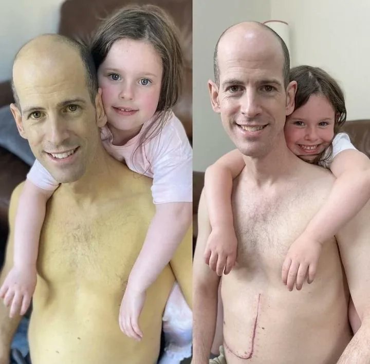 Rainmaker1973's tweet photo. This father before and after a liver transplant https://t.co/qkjM1hWy9h