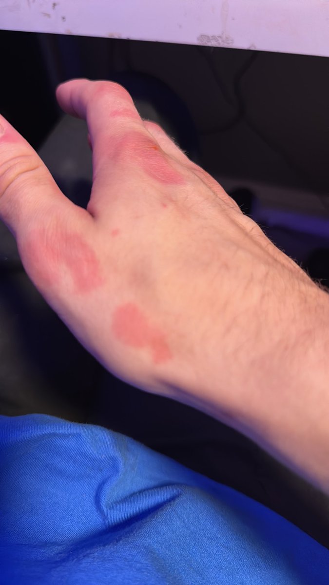 ayoooojax's tweet photo. this bruising is semi concerning should I see a doctor abt this or nah https://t.co/mWGqeQo52f