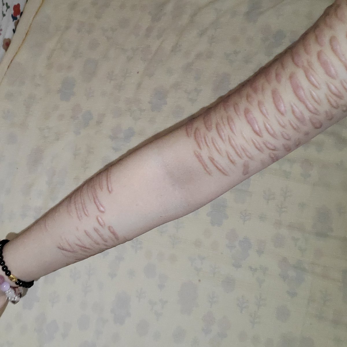 zz_mm96191's tweet photo. #Scars This is just a makeup effect, please carefully distinguish.°¯᷄◠¯᷅° https://t.co/xV2aBsCV0l