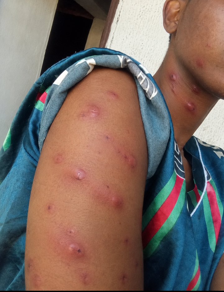 oma059764878624's tweet photo. I don't understand what's going on with me. Woke up this morning just to see this all over my body including my bumbum. What could be the cause 😭😭😭😭😭😭😭 https://t.co/W5VVsnAkY2
