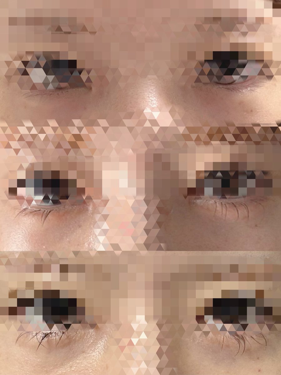 UxuxU_ee's tweet photo. @fact_psjp 

目の下脂肪再配置をして2ヶ月ちょっとたちました！上がする前です！
左右同じくらいの涙袋がすっぴんでもあるのが嬉しいです！💭もう少ししたら足したいなとおもいますがナチュラルで満足してます😊 https://t.co/UUEBKw7ipr