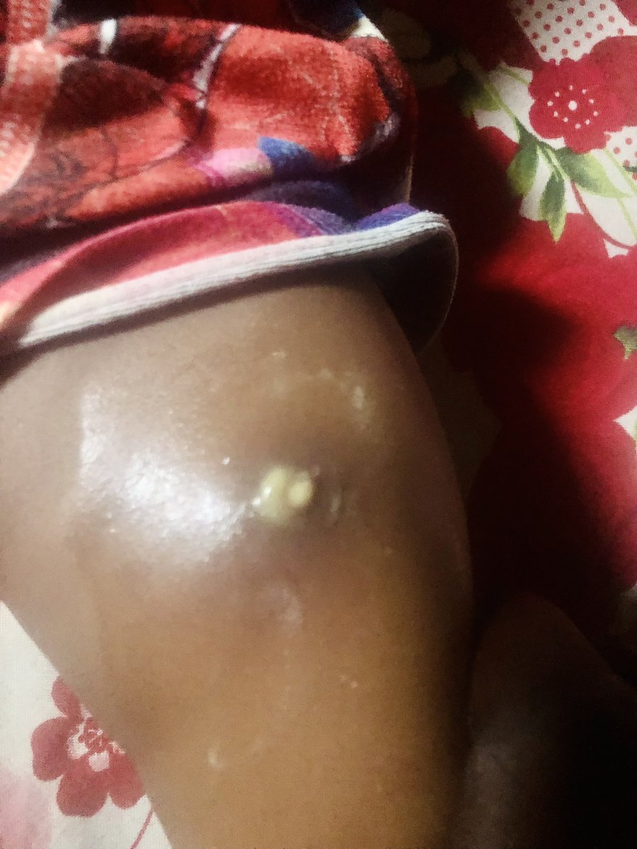 TeeMento's tweet photo. I got the shock of my life last night. My son complained to me that his sister had been scratching her leg, that maybe something bit her. Because I was vibing on X, I just told him to tell her mum to apply something to it, that it would go.

Only for me to hear my wife shouting, “Babe, come and see, something is coming out from her leg.” I thought it was pus, so I said nonchalantly that since they had applied something, it was the pus coming out from the swelling and she should leave it so it would come out completely. She insisted I should come and see it, that she wasn't sure it was pus.

I went to the room only to see something like a vein or something coming out. I was scared, so I touched it and tried to pull it, but it was very strong. I laid my girl down and tried to apply a little pressure for it to come out, but it remained stuck. At that moment I almost threw away my masculine energy, but mo fi okan okunrin gbe.

I pressed it one more time and the thing just came out like a worm 🐛. “What is this?” we both shouted! The surface was open as you can see from the picture, so we applied ointment and my girl felt relieved. This morning the open wound have closed up and I've told my wife to take her to the pharmacy with the worm-like thing so they could explain to her. Please I will like to know what’s that cause of that, doctors or pharmacist in the house.