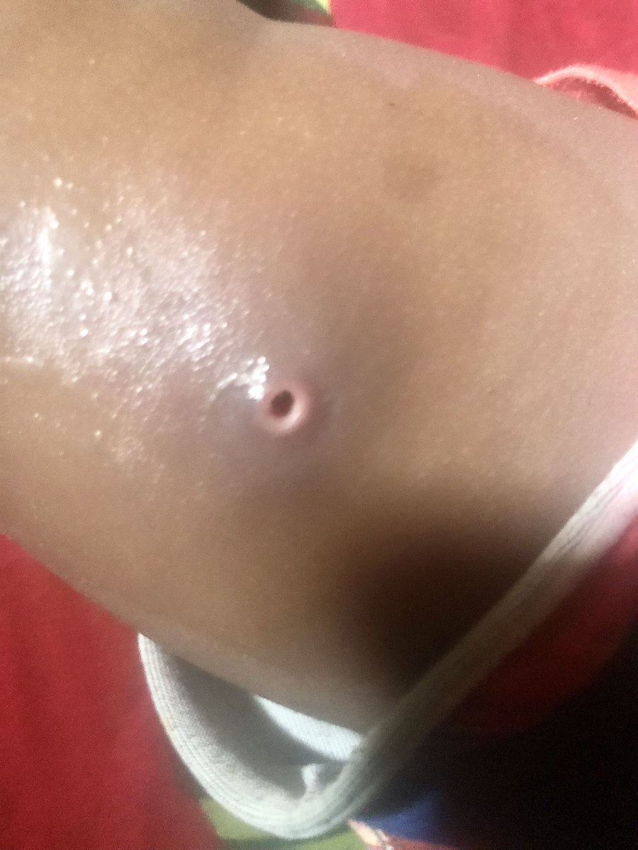 TeeMento's tweet photo. I got the shock of my life last night. My son complained to me that his sister had been scratching her leg, that maybe something bit her. Because I was vibing on X, I just told him to tell her mum to apply something to it, that it would go.

Only for me to hear my wife shouting, “Babe, come and see, something is coming out from her leg.” I thought it was pus, so I said nonchalantly that since they had applied something, it was the pus coming out from the swelling and she should leave it so it would come out completely. She insisted I should come and see it, that she wasn't sure it was pus.

I went to the room only to see something like a vein or something coming out. I was scared, so I touched it and tried to pull it, but it was very strong. I laid my girl down and tried to apply a little pressure for it to come out, but it remained stuck. At that moment I almost threw away my masculine energy, but mo fi okan okunrin gbe.

I pressed it one more time and the thing just came out like a worm 🐛. “What is this?” we both shouted! The surface was open as you can see from the picture, so we applied ointment and my girl felt relieved. This morning the open wound have closed up and I've told my wife to take her to the pharmacy with the worm-like thing so they could explain to her. Please I will like to know what’s that cause of that, doctors or pharmacist in the house.