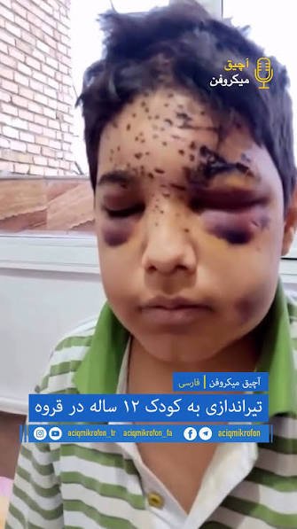 vinoxer2's tweet photo. @professor_766 اونی که به صورت این بچه شلیک کرده داره از کودک کشی حرف میرنه. https://t.co/kP9CJc5TPK