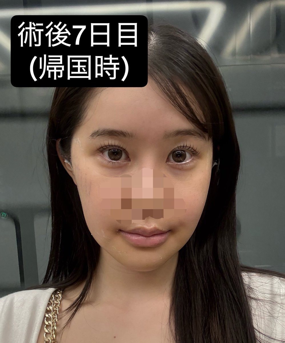 輪郭整形後の予定を立てる時、「腫れが引くまで」だけで考えないで‼️

輪郭整形は、"見た目のDT"と、"仕事等で自然に話せるまでのDT"は別物👋

私は術後1週間で見た目はかなり落ち着いていたけど、下顎の麻痺で口元が動かしにくくて、話し方はまだ不自然だった🥲

術後17日で、 https://t.co/3ecTFeFwXh