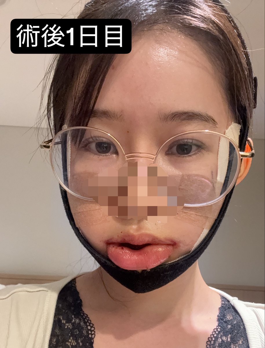 輪郭整形後の予定を立てる時、「腫れが引くまで」だけで考えないで‼️

輪郭整形は、"見た目のDT"と、"仕事等で自然に話せるまでのDT"は別物👋

私は術後1週間で見た目はかなり落ち着いていたけど、下顎の麻痺で口元が動かしにくくて、話し方はまだ不自然だった🥲

術後17日で、 https://t.co/3ecTFeFwXh