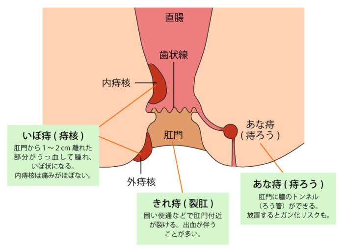 実は痔で死にかけたことあって...

でもこれ飲むようになってからお通じ良くなりすぎてお腹ぺたんこwww

朝一大量💩日中も出て…💩
便秘に悩んでる人はこれ試してみて欲しい‼️ https://t.co/vjW89aJEpC