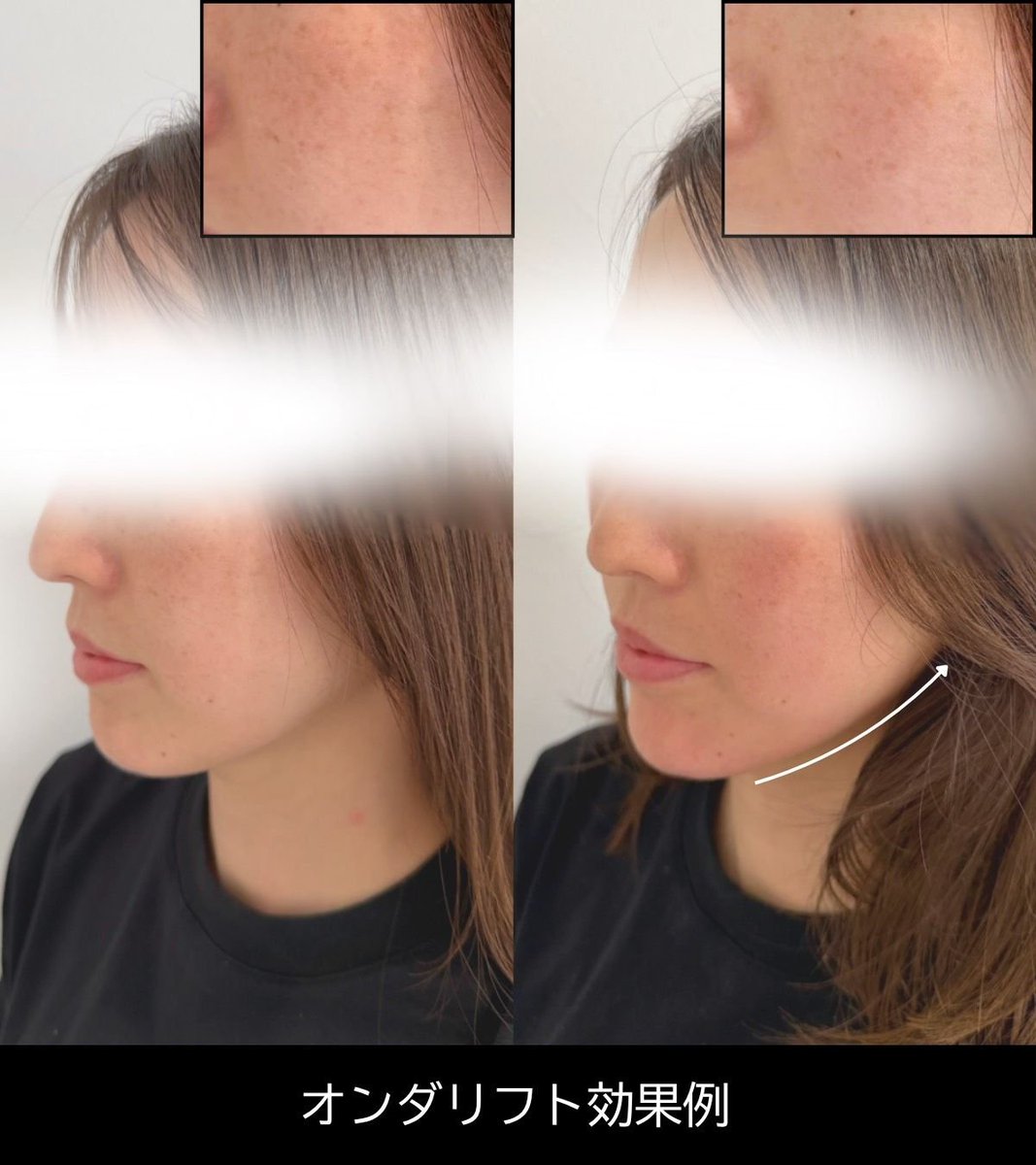 韓国で大流行中のオンダリフトが凄すぎる!切らずに「最強のVライン」が叶うから、糸リフト迷ってる子は全員受けてほしい🥺
一回でフェイスラインのもたつきが消えて、加工並みの小顔に!痛みもダウンタイムもほぼゼロだから施術後すぐお出かけOK!【PR】 https://t.co/0vXYwqBoXX