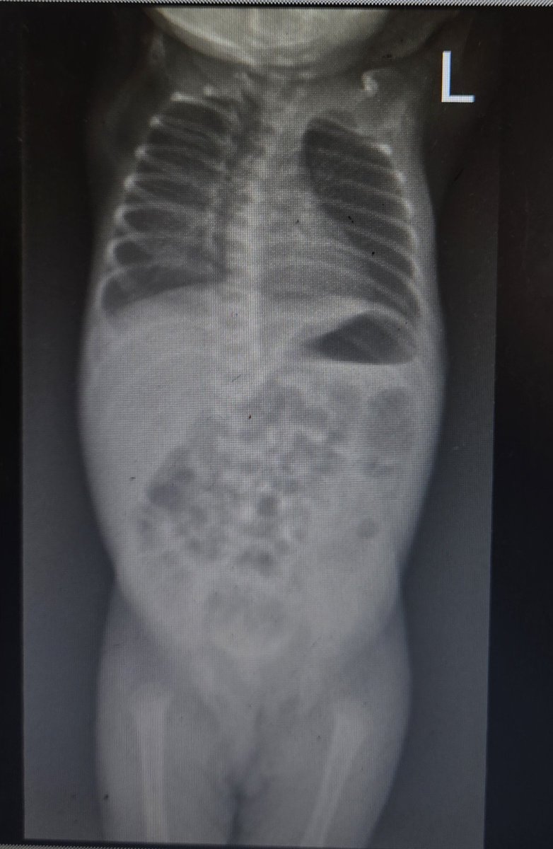 Kaf_Dan's tweet photo. Kaf Clinical Series 🩺 | Case 03

23-day-old F with omphalitis and 4 days without stool, though passing flatus.

AXR shows diffuse gaseous bowel distension with absent rectal gas. No pneumoperitoneum, pnematosis and no portal venous gas.

What is the cause of the constipation? https://t.co/9t8BI3j5Xy