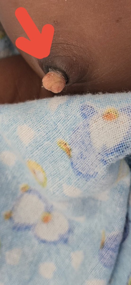 Kaf_Dan's tweet photo. Kaf Clinical Series 🩺 | Case 03

23-day-old F with omphalitis and 4 days without stool, though passing flatus.

AXR shows diffuse gaseous bowel distension with absent rectal gas. No pneumoperitoneum, pnematosis and no portal venous gas.

What is the cause of the constipation? https://t.co/9t8BI3j5Xy