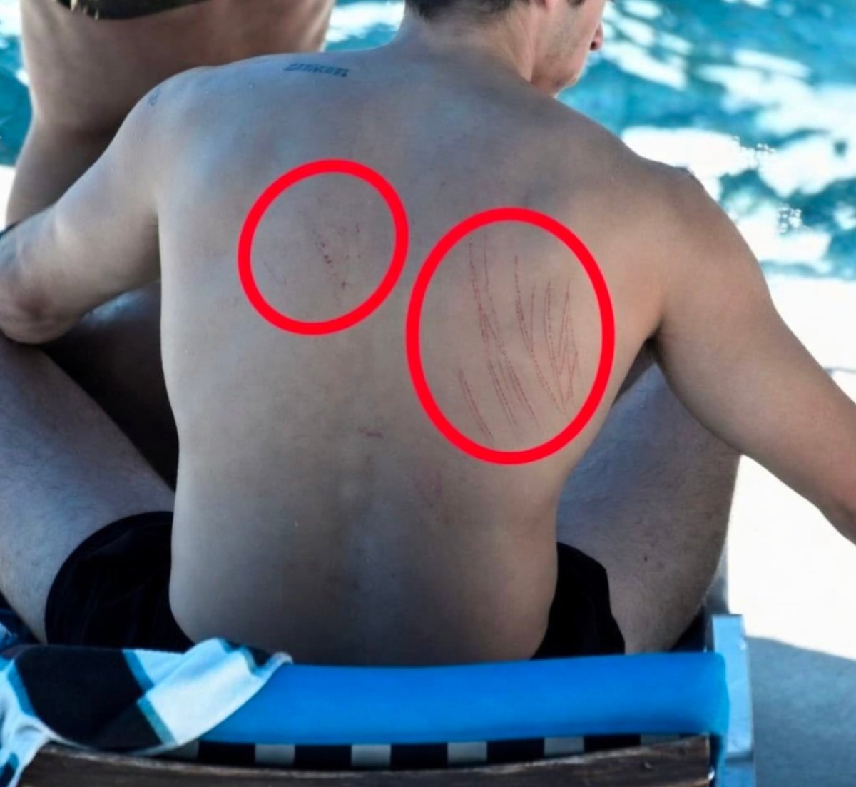 Angelinavx11's tweet photo. Hey @grok, Dua Lipa’s husband has these marks on his back—what exactly are they? https://t.co/RvIq8WNAb8