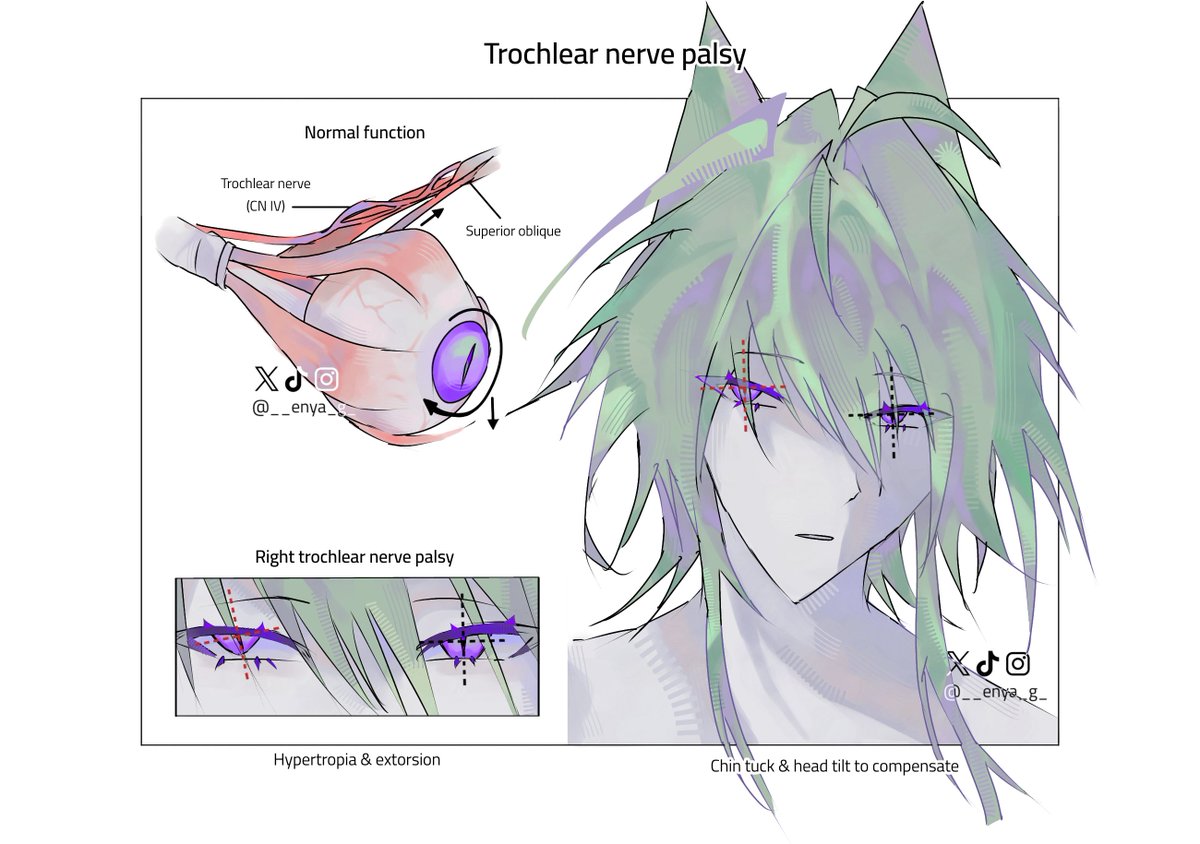 __enya_g_'s tweet photo. trochlear nerve palsy #oc https://t.co/zhcqMOsVrT