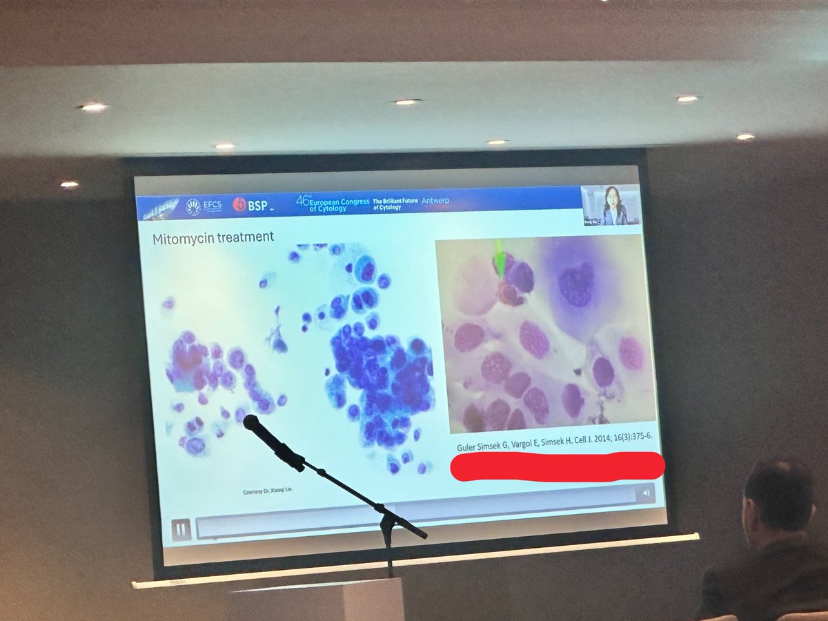 glinglerimek's tweet photo. @chriszioga @PapSociety urinary cytology  Session at #ECC2026 in Antwerp! So happy to see my old case report in the presentation. Thanks all of you @aakasharmand @DianaEstherossi @PoonamVohra3 @mdlozanoe @AzizaNassar2 @JM_CytoBox @ElmasHatice1 @binnuronal https://t.co/gv3q6Rf7bL