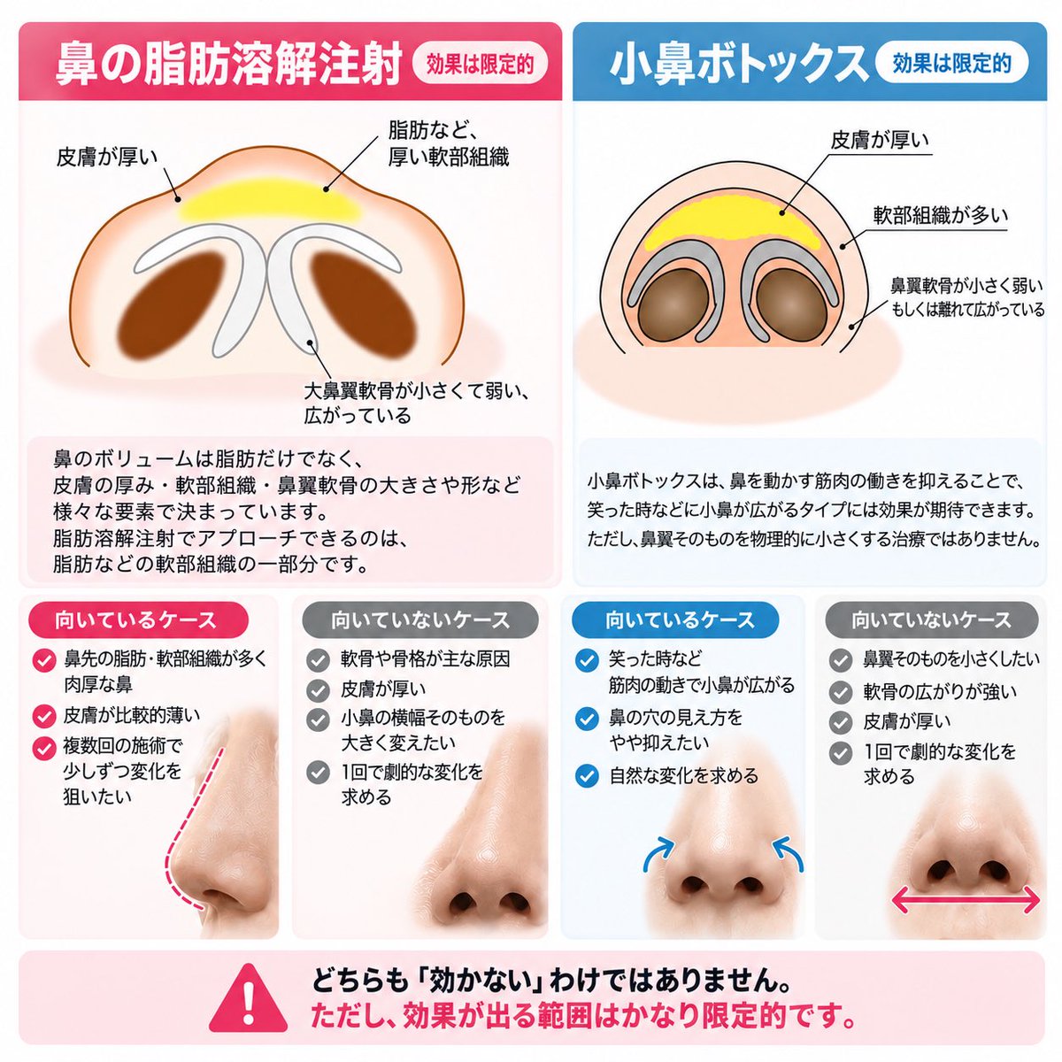 biyou_suki_up's tweet photo. 【「期待値を下げる」鼻治療2選】

はっきり物申します☝️

カウンセリングで期待値を下げる治療、二大巨頭⤵️
🥇「鼻の脂肪溶解注射」
🥈「小鼻ボトックス」

画像を見ると分かりやすいですが、鼻のボリュームは脂肪だけで決まりません🙅‍♀️

・皮膚の厚み
・脂肪などの軟部組織
・鼻翼軟骨の大きさ・形
・小鼻の広がり

いろんな要素で鼻の形は決まっています👌🏻
なので、脂肪溶解注射でアプローチできるのは、基本的に脂肪などの軟部組織の一部分。

脂肪が原因の「肉厚な鼻」なら変化は期待できますが、軟骨や皮膚の厚みが主因なら、脂肪を減らしても限界があります。

そして小鼻ボトックスも同じ。

笑った時など、筋肉の動きで小鼻が広がるタイプには◎。
でも、鼻翼そのものを物理的に小さくする治療ではありません。

「効かない」ではなく...
“効く範囲がかなり限定されている”が正しいと思っています🤔

SNSで劇的な症例を見ると期待してしまいますが、施術前に「どこまで変わるのか」をはっきり伝えるのも大事🔥

『鼻の脂肪溶解注射 × 小鼻ボトックス』個人的には“過度な期待を下げる二大巨頭”です🙄

ここまで読んだ方へ...本音。
『鼻の脂肪溶解注射は非推奨』☝️