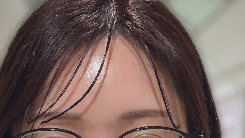 水光注射って痛みえぐいし、持続は長くないけど唯一無二の艶が出ると思ってる。イベントの1週間くらい前とかにやるとめちゃくちゃいいよね。ちなみにこれ、後から気付いたけどリトゥオというか水光注射（ハイコックス注入）ならではの艶だった🥹 https://t.co/zIl2Cd9uMl