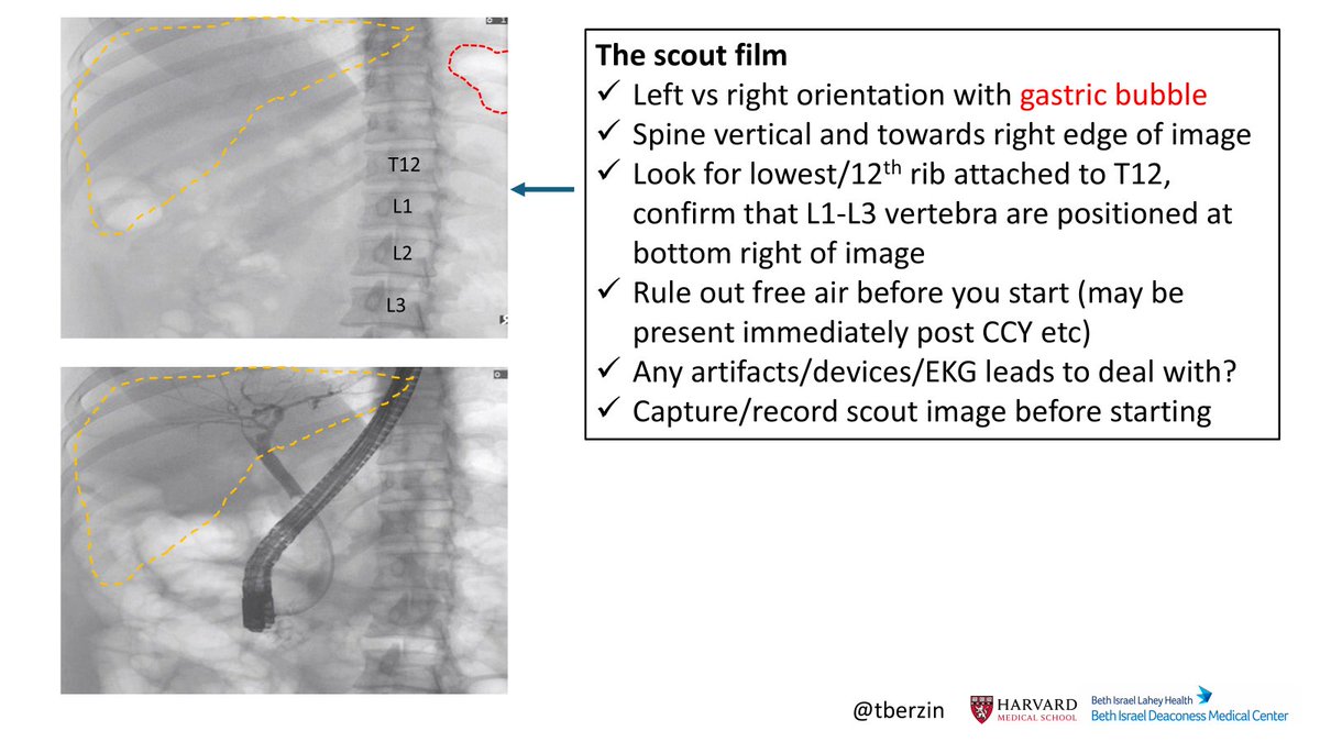 tberzin's tweet photo. The scout film is an underappreciated starting point for successful ERCP.

Before the scope goes in:
– Orient with the gastric bubble
– Use 12th rib to identify T12 
- Then position L1–L3 at bottom right of image
– Rule out free air *before* you start and save image https://t.co/7tpj3ZBsdl