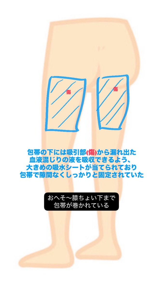bcuzkikuz's tweet photo. ✅追記
・包帯部分の説明と出血について
・脇の傷についての感想
・圧迫着についての色々
・手術当日にクリニックから
　受け取った資料の一部 https://t.co/qcHD0pbnLr