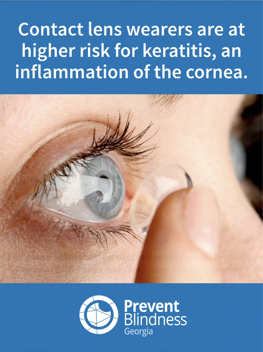 PBGA's tweet photo. Healthy eyes start with healthy contact lens habits! Contact lens wearers can be at higher risk for keratitis. Reduce your risk by washing hands before handling lenses, cleaning &amp; storing them as directed &amp; never sleeping in them unless your eye care professional says it’s safe. https://t.co/ncIfvySpvR