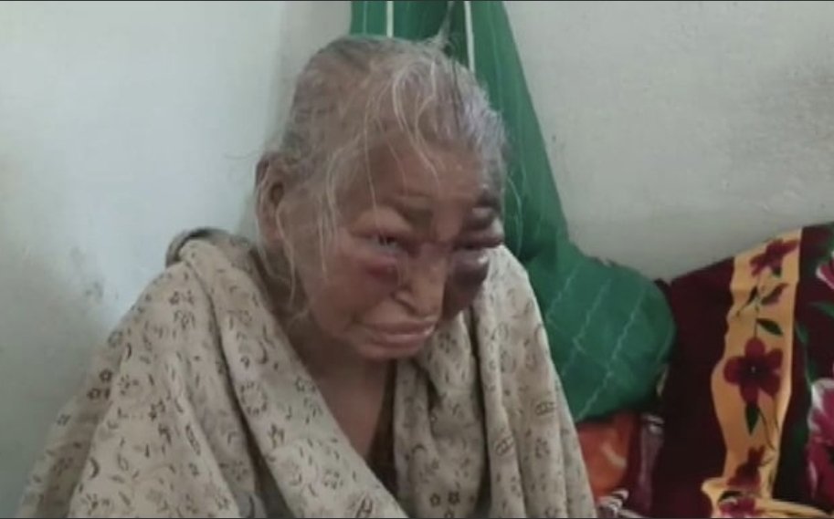DasCapital8's tweet photo. Shova Majumder, an 85 year old mother of a BJP worker was beaten black and blue by TMC and later she succumbed to the injuries and passed away 

Koyel Mallik and her father supported TMC after all of this, they joined the party actively post this 

Koyel has been inducted in BJP https://t.co/BIWaDPxUpU