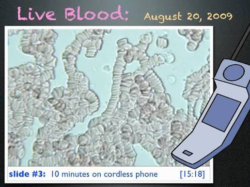 Anti5GWarrior's tweet photo. @SmartScience Dr Magda Havas and Rouleaux Formation (blood clumping) caused by exposure to mobile phone radiation or wireless devices. 🛜☢️🩸

Short video:
https://t.co/IvJtNVuAr5 https://t.co/1B2ZsipVhO