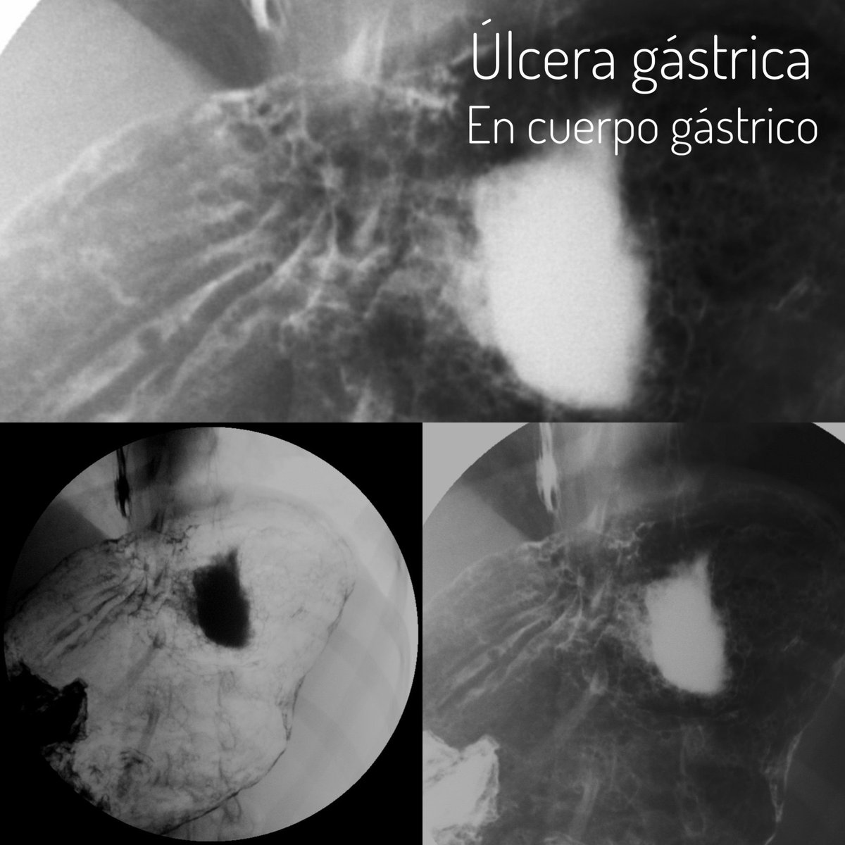 medic_radio's tweet photo. Así se ve una úlcera gástrica en un estudios de serie gastroduodenal; se observa un depósito de contraste con halo radiolucido (edema) con múltiples pliegues gástricos engrosados que confluyen al depósito y forman el nicho ulceroso. #ulceragastrica https://t.co/JFUSTVl5Zc