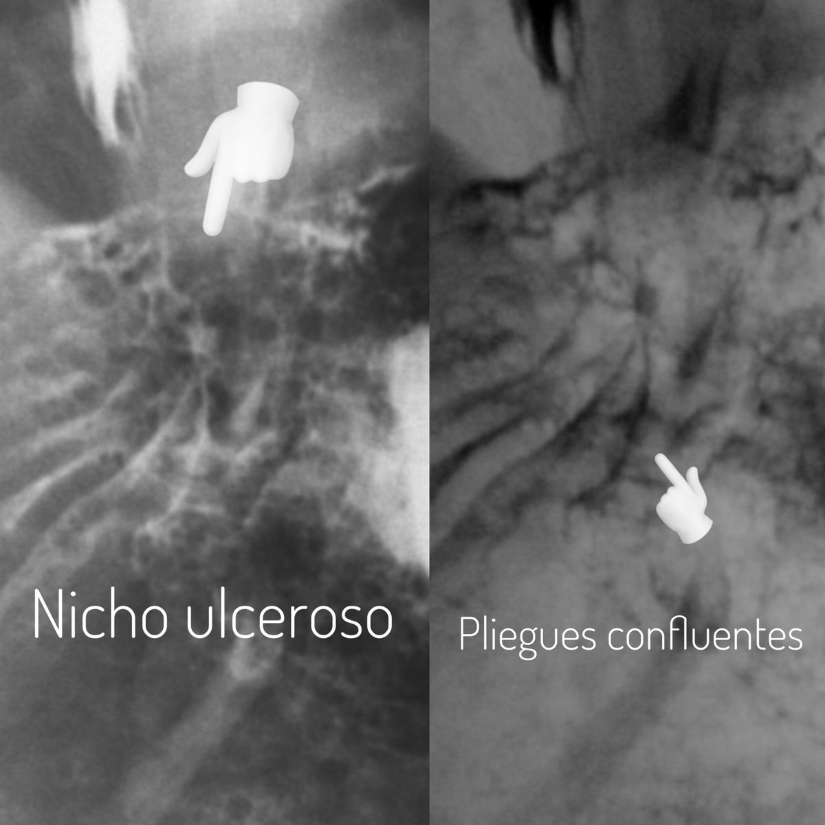 medic_radio's tweet photo. Así se ve una úlcera gástrica en un estudios de serie gastroduodenal; se observa un depósito de contraste con halo radiolucido (edema) con múltiples pliegues gástricos engrosados que confluyen al depósito y forman el nicho ulceroso. #ulceragastrica https://t.co/JFUSTVl5Zc